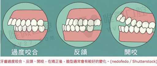 二氧化锆是全瓷牙吗（二氧化锆全瓷牙优缺点）(图1)